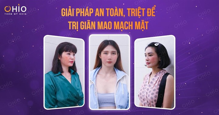 Giải pháp an toàn, triệt để trị giãn mao mạch mặt