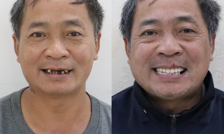Hành trình tìm lại hàm răng đã mất, khôi phục khả năng ăn nhai