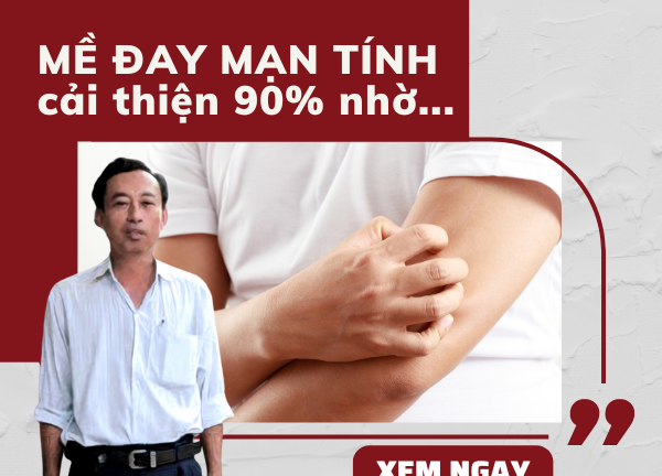 Mề đay mạn tính, hở chút là ngứa khắp người nhưng tôi đã cải thiện 90%