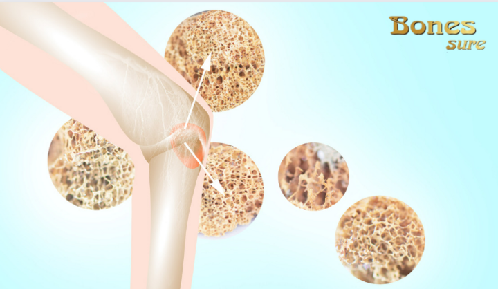 Sữa non Bones Sure - Dinh dưỡng “vàng” cho xương khớp khỏe mạnh