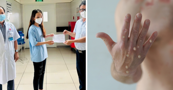 Bệnh nhân đậu mùa khỉ đầu tiên ở Bình Dương được ra viện