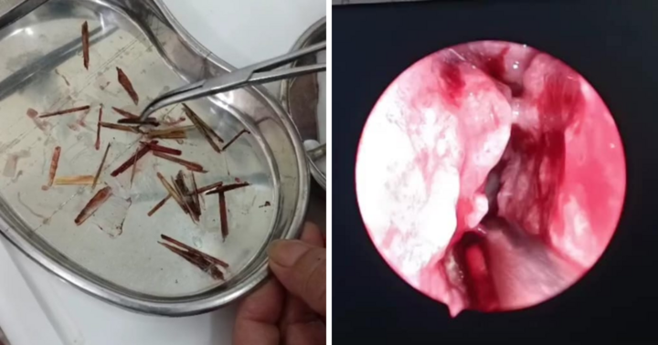 Hay chảy dịch và máu mũi, tá hỏa phát hiện 33 vật thể trong mũi cô gái