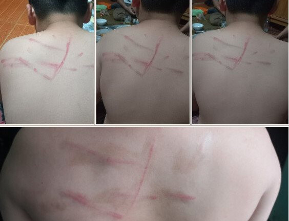 Chấm dứt hợp đồng với cô giáo dùng roi đánh học sinh lớp 4 tím lưng