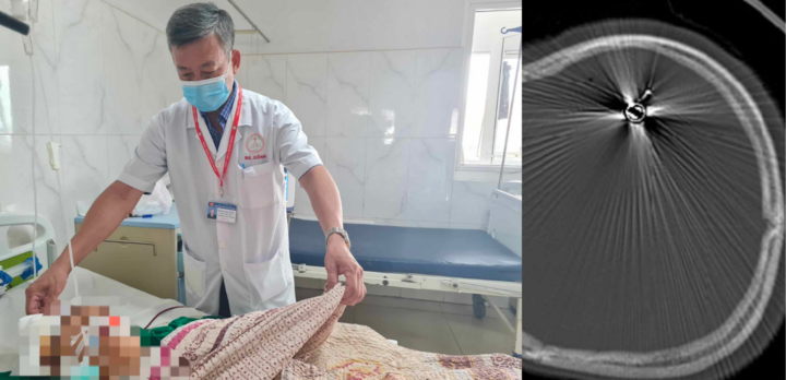 Đi qua nhà bạn chơi, bé trai 12 tuổi bị đạn bắn xuyên đầu