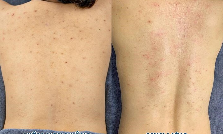 Sự khác biệt giữa viêm nang lông và mụn lưng – Nhận biết & giải pháp