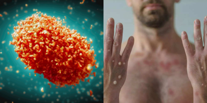 Phát hiện thêm 4 ca mắc đậu mùa khỉ tại TP.HCM