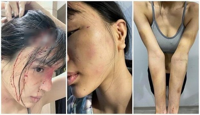 Vụ nữ siêu mẫu tố chồng chưa cưới hành hung: Công an vào cuộc xác minh