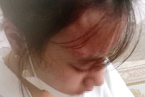 Vụ nữ sinh ở Hà Tĩnh bị đánh chấn động não: Đi mua kim khâu gặp tai họa