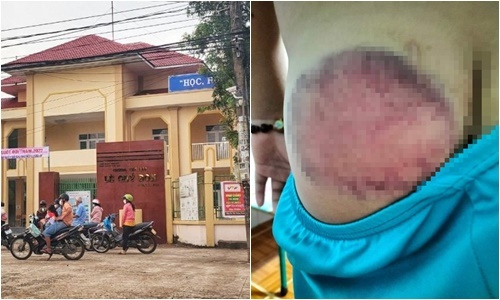 Quên mang sách, học sinh lớp 4 bị thầy giáo đánh bầm tím mông 