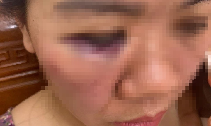 Nữ cán bộ Điện lực ở Hà Tĩnh bị nam đồng nghiệp đánh vì bất đồng quan điểm