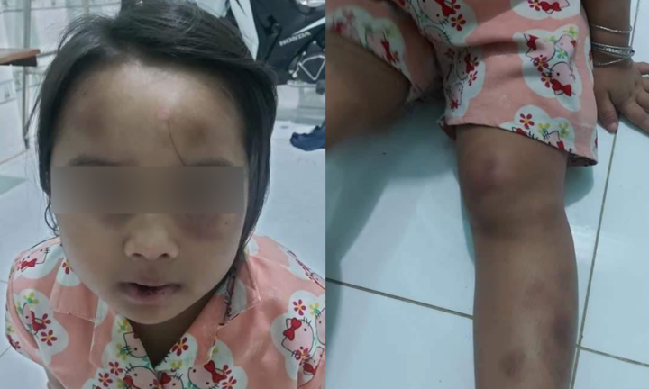 Cha về quê, con gái 6 tuổi bị vợ chồng cô ruột đánh đập tàn bạo