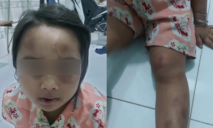 Tin tức thời sự mới nóng nhất hôm nay 18/7: Bé gái 6 tuổi bị vợ chồng cô ruột đánh đập tàn bạo