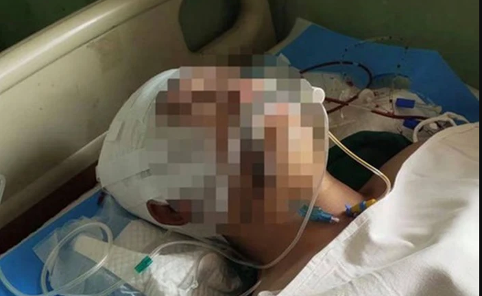 Đọc được tin nhắn nói xấu, 2 thầy giáo đánh nam sinh 15 tuổi đến xuất huyết não