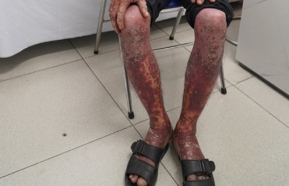 Thuốc diệt cỏ thấm qua quần áo, người đàn ông ngộ độc toàn thân