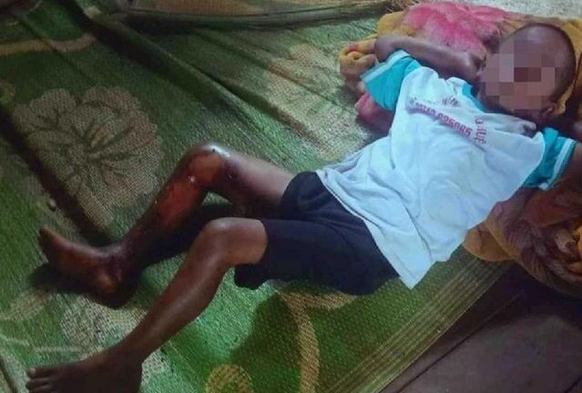 Vụ bé 8 tuổi bị đốt bỏng chân ở Đắk Lắk: Khởi tố nam thanh niên liên quan