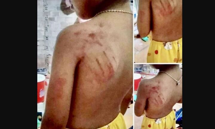 Bà Rịa - Vũng Tàu: Tiếp thu bài chậm, học sinh lớp 1 bị cô giáo đánh bầm vai