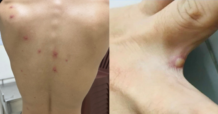 Phát hiện thêm 1 ca bệnh đậu mùa khỉ ở TP.HCM