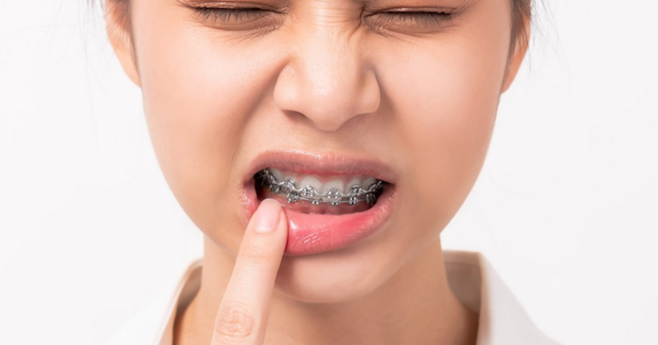Mối nguy rình rập khi lỡ niềng răng sai cách và cách chăm sóc sau khi