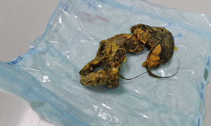 Phẫu thuật thành công lấy búi tóc lớn trong ruột bé gái 4 tuổi