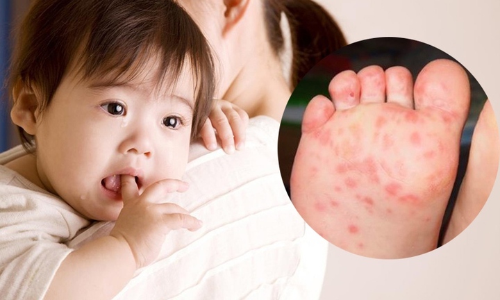 Những biến chứng nguy hiểm nếu trẻ mắc bệnh tay chân miệng chủng virus EV71