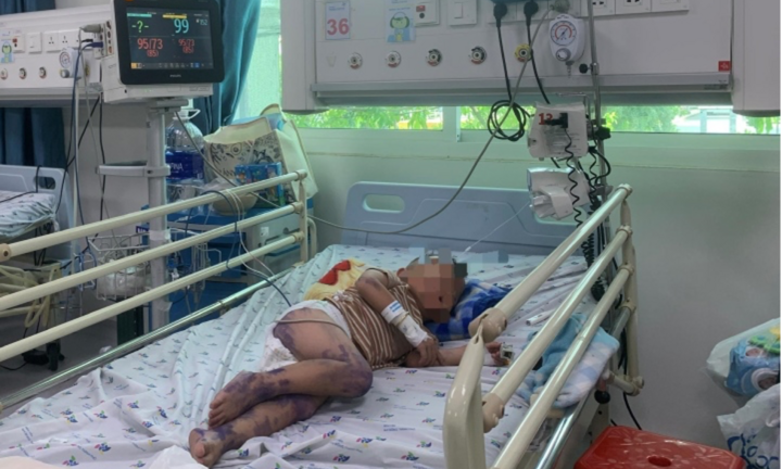 Virus gây bệnh tay chân miệng nặng ở trẻ em tái xuất tại TP.HCM