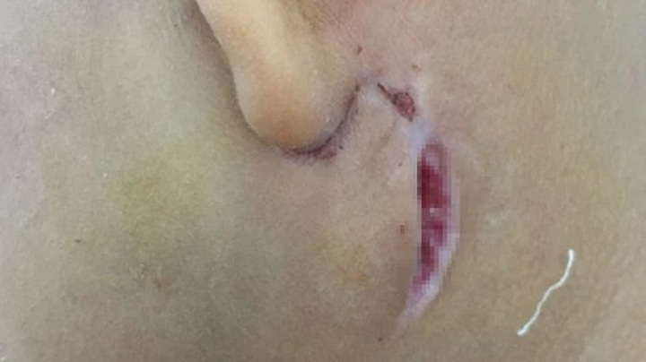 Bệnh nhân nhiễm vi khuẩn ăn thịt người tại Buôn Ma Thuột là tài xế