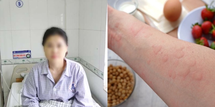 Nghĩ sau 20 năm hết dị ứng, cô gái trẻ phải đi cấp cứu vì sốc phản vệ