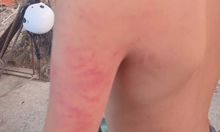 Xác minh vụ một học sinh lớp 1 ở Long An bị giáo viên đánh bầm tím khắp người