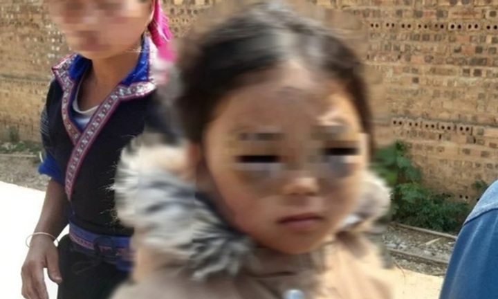 Vụ học sinh lớp 1 nghi bị cô giáo đánh ở Yên Bái: Diễn biến mới nhất