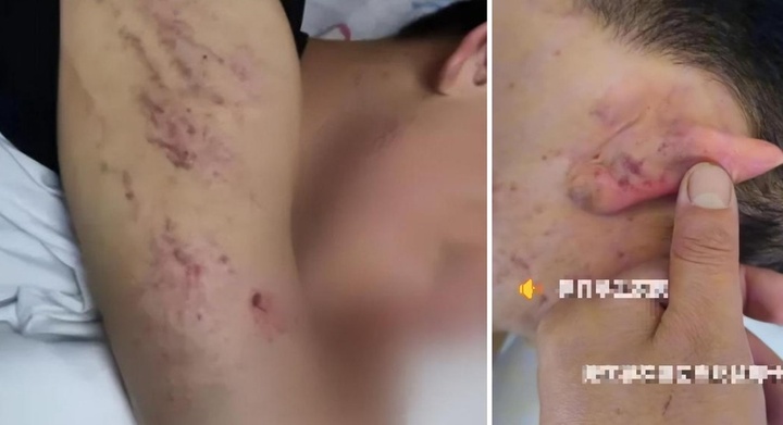 Học sinh bị đánh hội đồng, phụ huynh bức xúc vì cách xử lý 