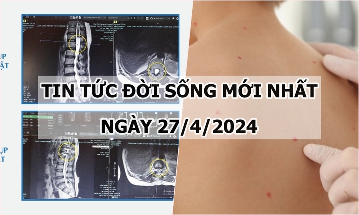 Tin tức đời sống ngày 27/4/2024: Đau lưng kéo dài, phát hiện khối u tủy ngực chèn ép tủy sống