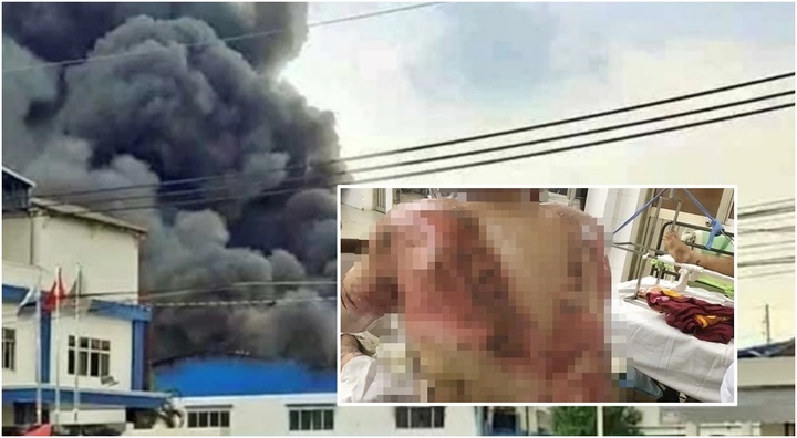 Vụ cháy lớn ở Đồng Nai: Nam công nhân bỏng nặng, khả năng phải ghép da