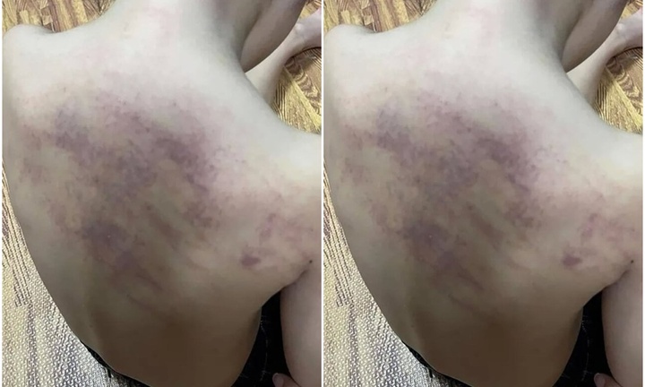 Tình tiết mới vụ bé 5 tuổi bị bầm tím khi đi học ở Hải Phòng: Quận báo cáo gì?