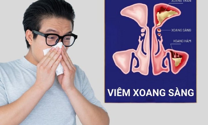 Đẩy lùi viêm xoang sàng tại nhà hiệu quả nhờ Xịt mũi họng Khiết Thanh