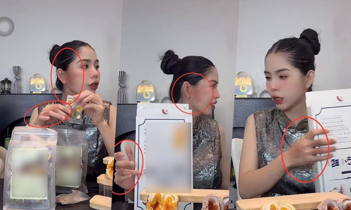 Cận cảnh những vết bầm tím trên cơ thể Hằng Du Mục