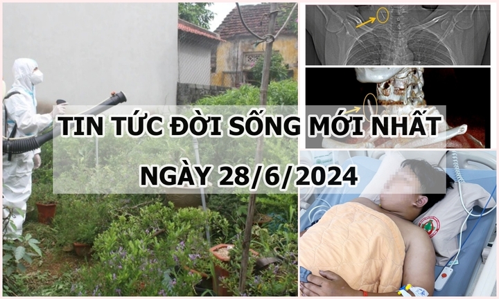 Tin tức đời sống ngày 28/6/2024: Người đàn ông bị đinh sắt cắm vào cổ nhưng không biết