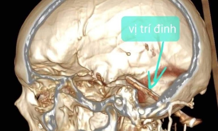 Thấy bất thường đi viện kiểm tra, bàng hoàng khi nhận kết quả