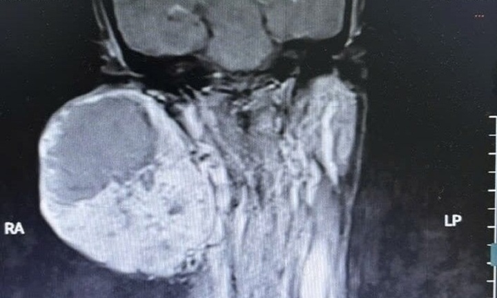 Sống chung với khối u khổng lồ 14 năm không điều trị, người phụ nữ suýt mất mạng