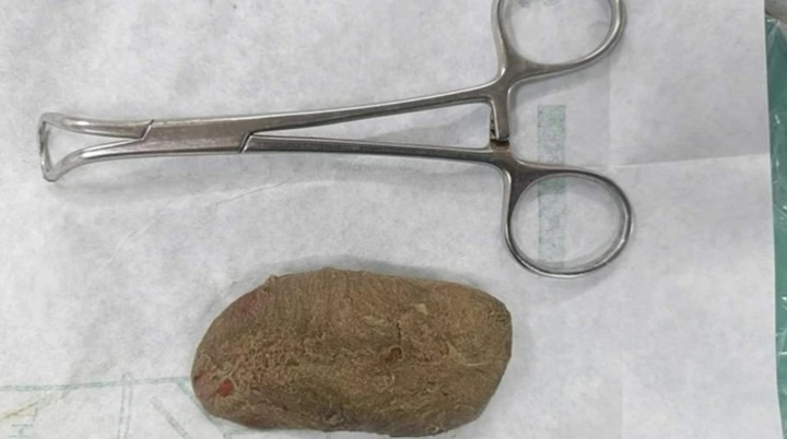 Cứu sống người đàn ông tắc ruột do nuốt phải dị vật lạ