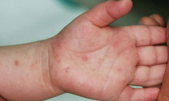 Hà Nội dự báo ca mắc tay chân miệng tăng khi trẻ đi học trở lại