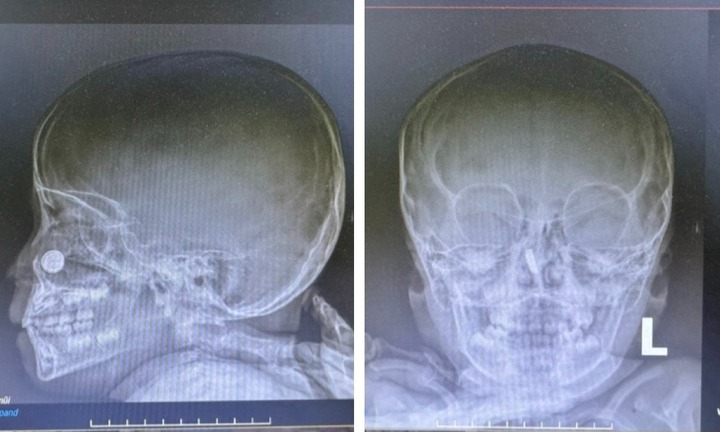 Bé trai 3 tuổi nhập viện vì nhét viên pin vào mũi, bác sĩ cảnh báo nguy hiểm