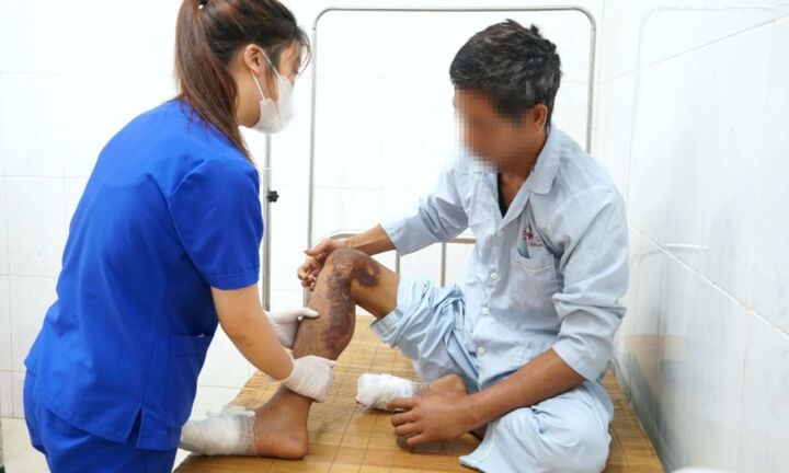 Người đàn ông bỏng nặng do điện giật khi đang làm việc