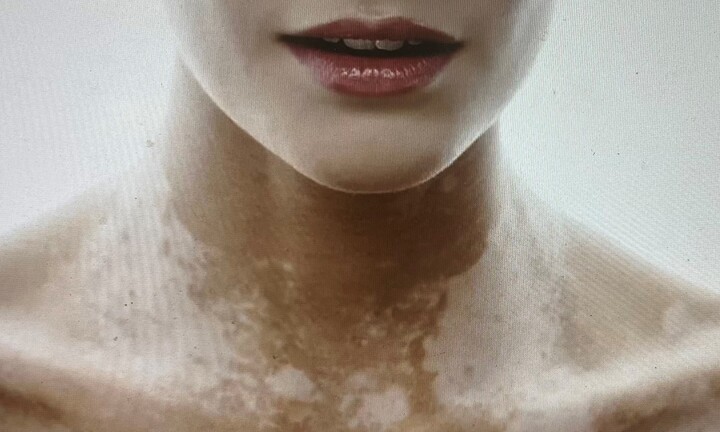 Đông y Bảo Thanh Đường khắc tinh của bệnh bạch biến 