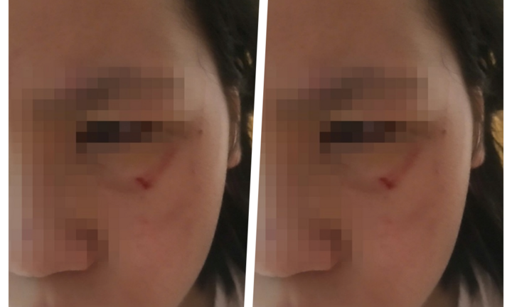 Vụ nữ sinh lớp 5 ở Hà Nội bị đánh rách mặt ngay tại trường: Công an thông báo kết quả giải quyết