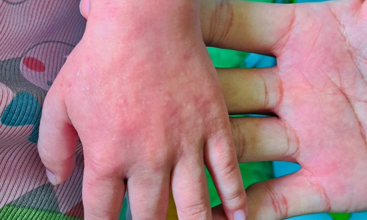TP.HCM: Số ca mắc sởi gia tăng, nhiều trường học bỏ sót trẻ chưa tiêm vaccine