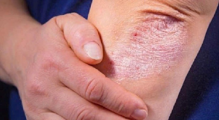 Có nên tự dùng thuốc để chữa bệnh vảy nến?