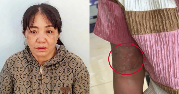 Khởi tố, bắt tạm giam mẹ nuôi tạt nước sôi vào bé gái 12 tuổi vì làm mất vé số