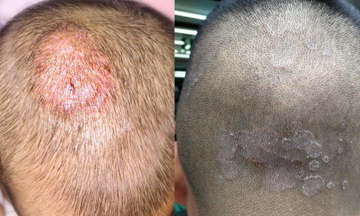 Làm thế nào để trị gàu nhanh nhất, ngừa tái phát?