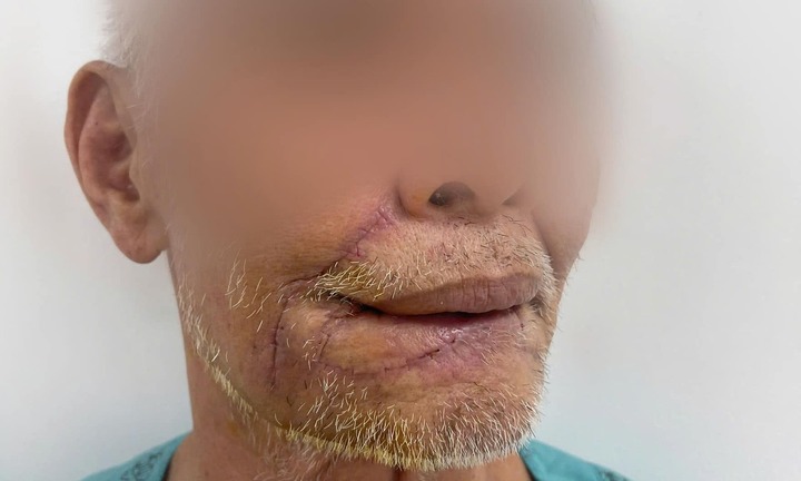 Tạo hình vùng mặt cho ông cụ 72 tuổi bị chó cắn đứt rời môi