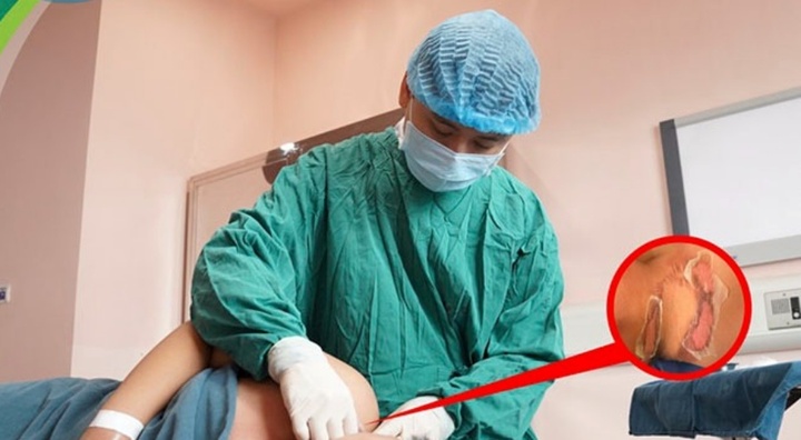 Bé trai 12 tuổi ở Hà Nội bỏng toàn thân vì bất cẩn khi tắm bằng vòi hoa sen